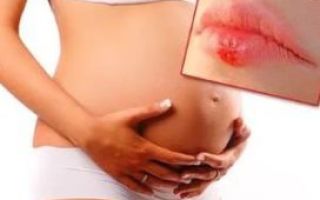 Герпес у грудного ребенка: симптомы и лечение