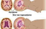 Узи головного мозга у грудничка: норма и нарушения