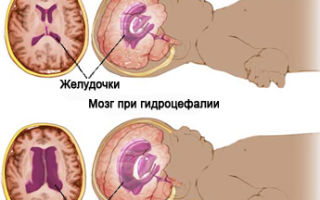 Узи головного мозга у грудничка: норма и нарушения