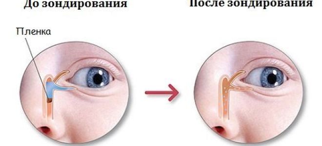 Зондирование слезного канала у новорожденных: как проводится, показания и последствия