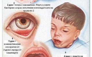 Коклюш у детей до года: симптомы, формы заболевания, методы лечения и профилактики