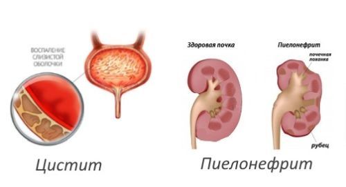 Лейкоциты в моче у грудничка: норма, причины повышения