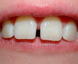 Прорезывание зубов у детей: когда начинают расти