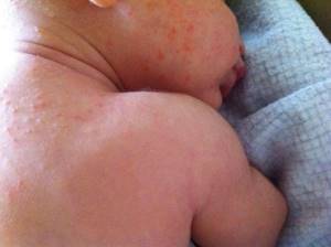 Непереносимость лактозы: симптомы у грудных детей