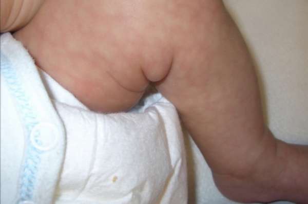 Мраморная кожа у грудничка: причины и лечение