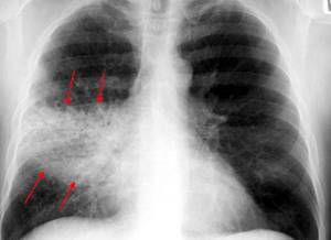Пневмония у грудничка: симптомы, признаки и лечение