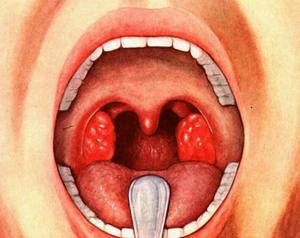 Мирамистин в горло грудничку: как применять и когда можно