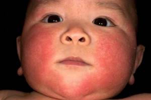 Как отличить потницу от аллергии у грудничка: советы и рекомендации