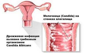 Лечение молочницы при грудном вскармливании