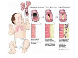 Хрипы у грудного ребенка: причины и лечение