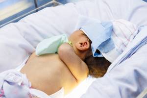 Геморрагическая болезнь новорожденных: причины, симптомы и лечение