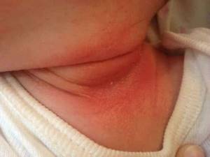 Виды высыпаний у грудничков: на лице, шее, животе и попе
