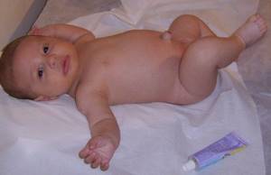 Бандаж для пупочной грыжи для новорожденных: виды и применение