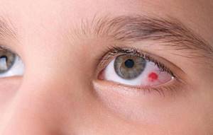 Проблемы с глазами у грудничка: косоглазие, желтые глаза, лопнул сосуд
