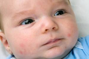 Аллергия на лице у грудничка: причины, что делать родителям