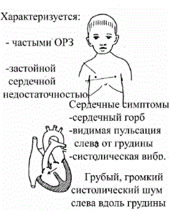 ДМЖП у новорожденного: причины дефекта межжелудочковой перегородки, симптомы и лечение