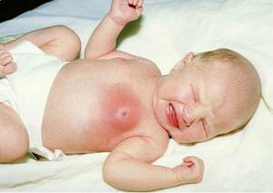 Набухание молочных желез у грудных детей: уплотнение или увеличение