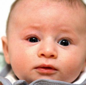 Дакриоцистит у новорожденных: симптомы и лечение, что делать