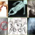 Тазобедренный сустав у грудничков: норма, признаки дисплазии и лечение
