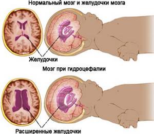 УЗИ головного мозга у грудничка: норма и нарушения