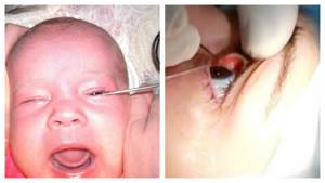 Массаж слезного канала у новорожденных: как правильно делать фото