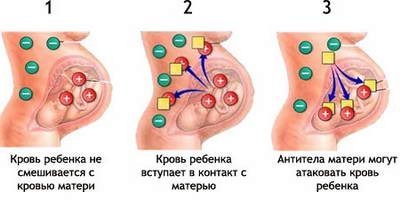 Гидроцефалия: симптомы у грудных детей