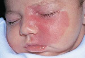Гемангиома у новорожденных: виды, причины возникновения и лечение