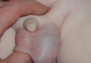 Водянка яичек у новорожденных мальчиков: причины и лечение
