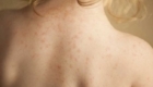 Как отличить потницу от аллергии у грудничка: советы и рекомендации