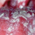 Белый налет на языке у грудничка: причины и лечение