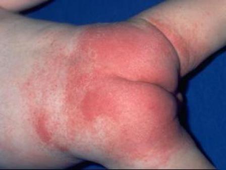 Красная попа у грудничка: причины раздражения кожи и чем лечить