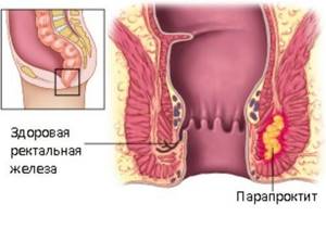 Парапроктит у грудничков: симптомы и лечение