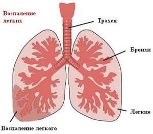 Пневмония у грудничка: симптомы, признаки и лечение