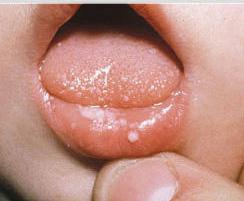 Белый налет на языке у грудничка: причины и лечение