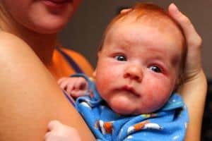 Дерматит у грудного ребенка: атопический, пеленочный, чем лечить