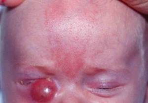 Зондирование слезного канала у новорожденных: как проводится, показания и последствия