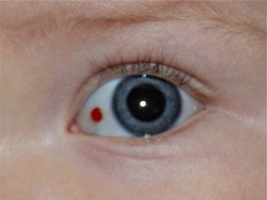 Проблемы с глазами у грудничка: косоглазие, желтые глаза, лопнул сосуд