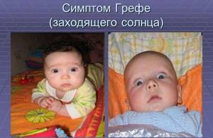 Новорожденный закатывает глаза: причины, диагностика и лечение, советы врачей