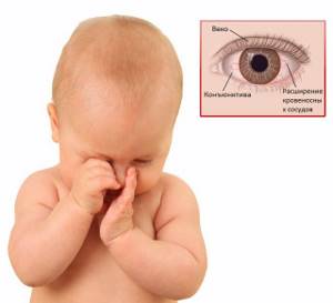 Конъюнктивит у грудничка: симптомы и лечение красных глаз