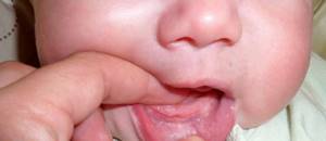 Белое пятнышко у грудничка на деснах, во рту и на языке