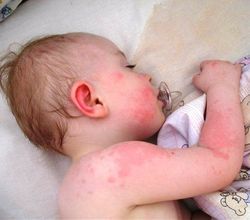 Лавровый лист от аллергии для новорожденных: как заваривать, пошаговые рецепты