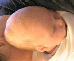 Кефалогематома у новорожденных: лечение и последствия