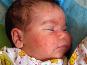 Аллергия на лице у грудничка: причины, что делать родителям