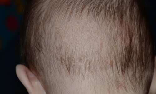 Выпадают волосы у грудничка 3­­–4 месяца на голове и затылке