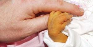 Гемолитическая болезнь новорожденных: причины, лечение, последствия и профилактика