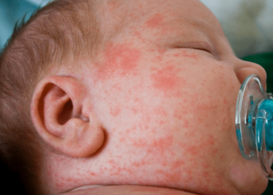 Прививка от гепатита в 1 месяц: побочные эффекты и реакции