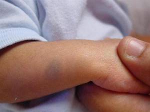 Монгольское пятно у новорожденного: что означает, причины появления, лечение