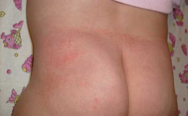 Красная попа у грудничка: причины раздражения кожи и чем лечить